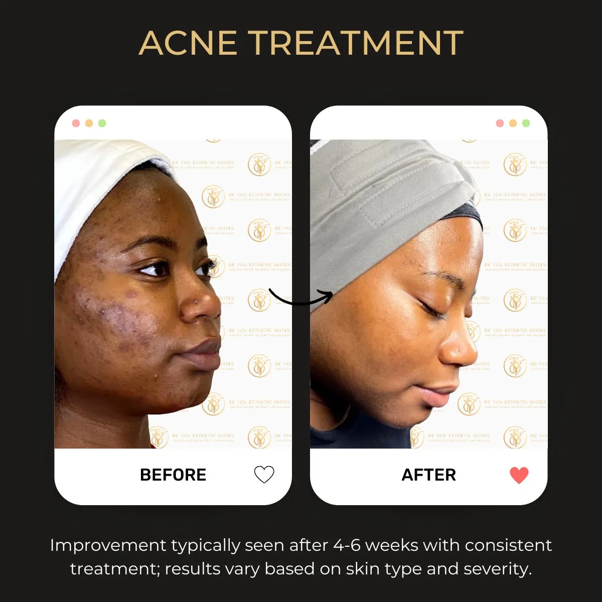 Before and after acne treatment images showcasing skin improvement at Be You Esthetics Suites.
