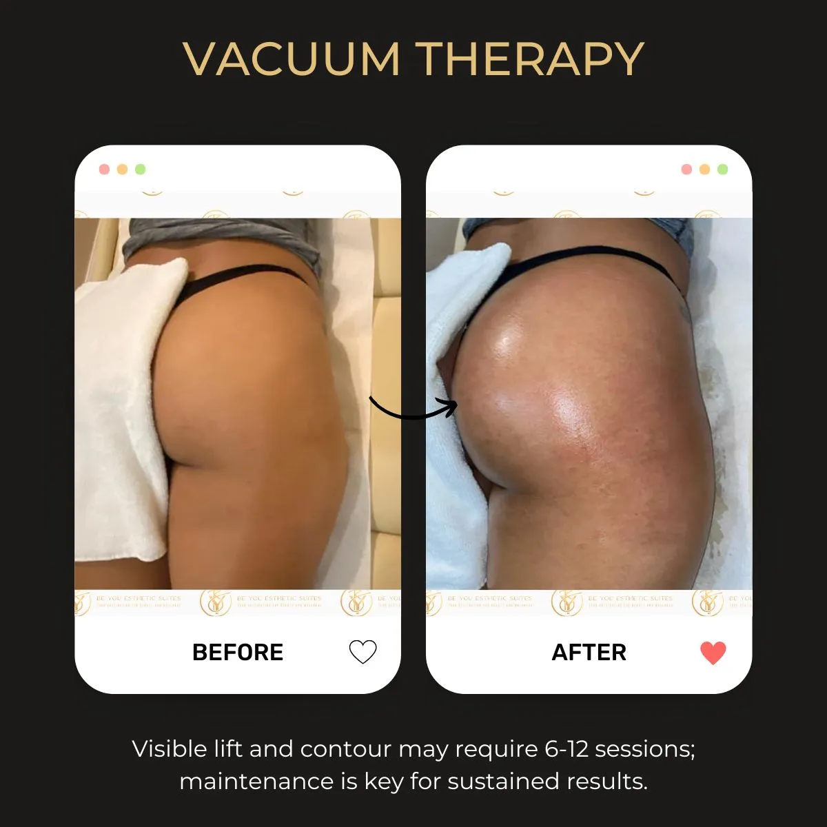 Vacuum butt lift before and after — Be You Esthetic Suites.