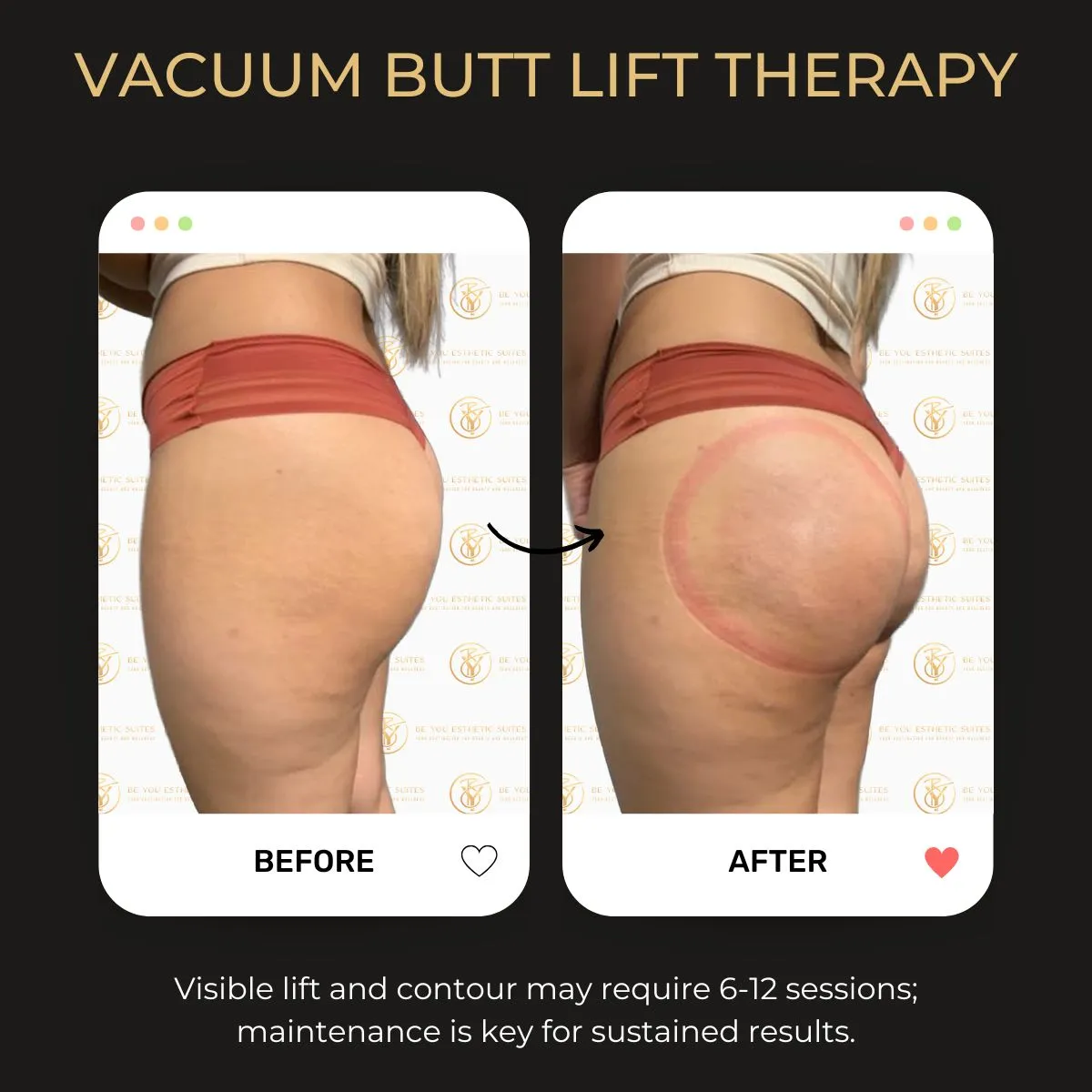 Vacuum butt lift before and after — Be You Esthetic Suites.