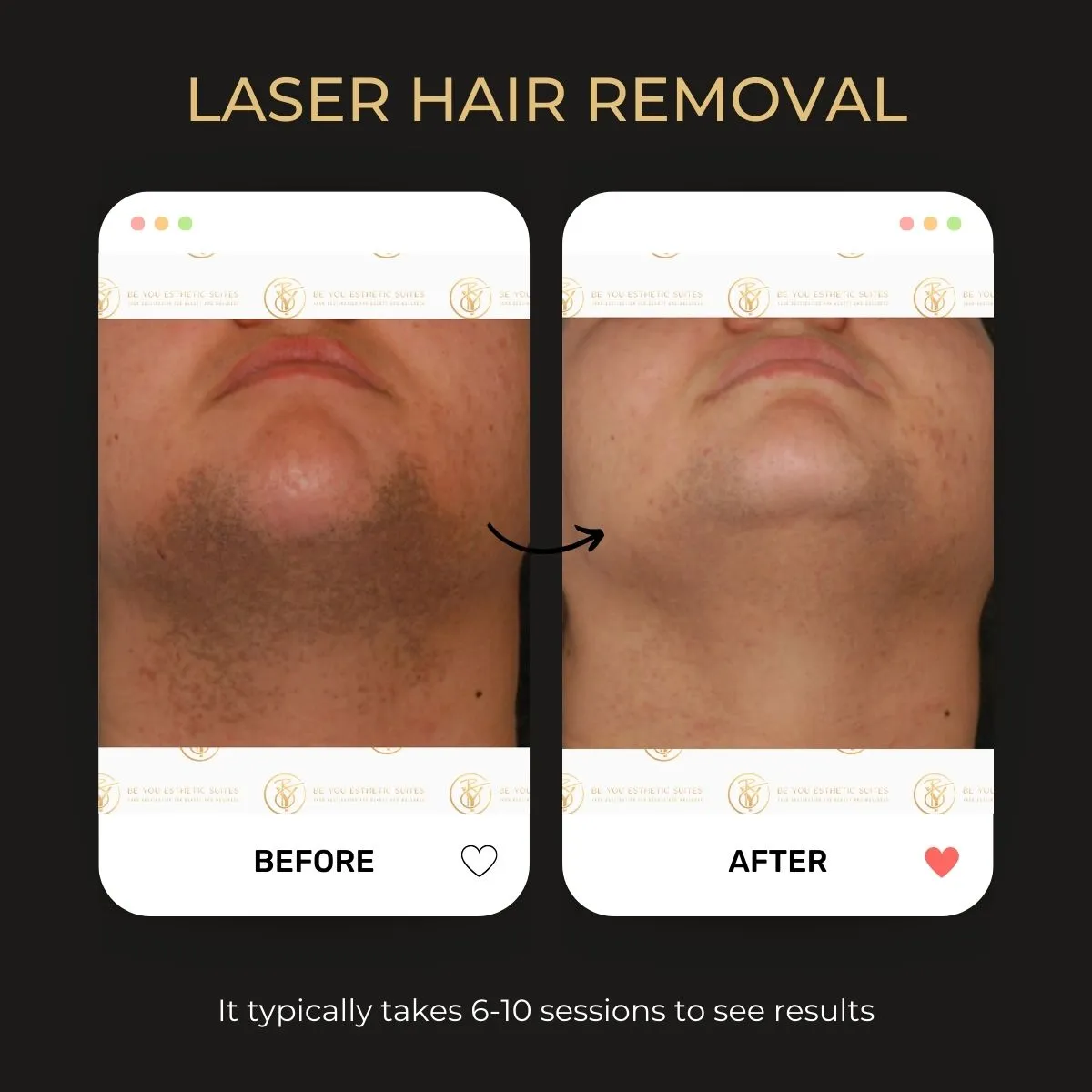 Laser hair removal before and after — Be You Esthetic Suites.