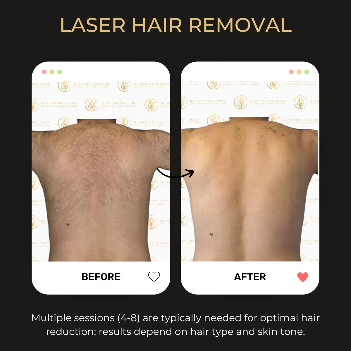 Laser hair removal before and after — Be You Esthetic Suites.