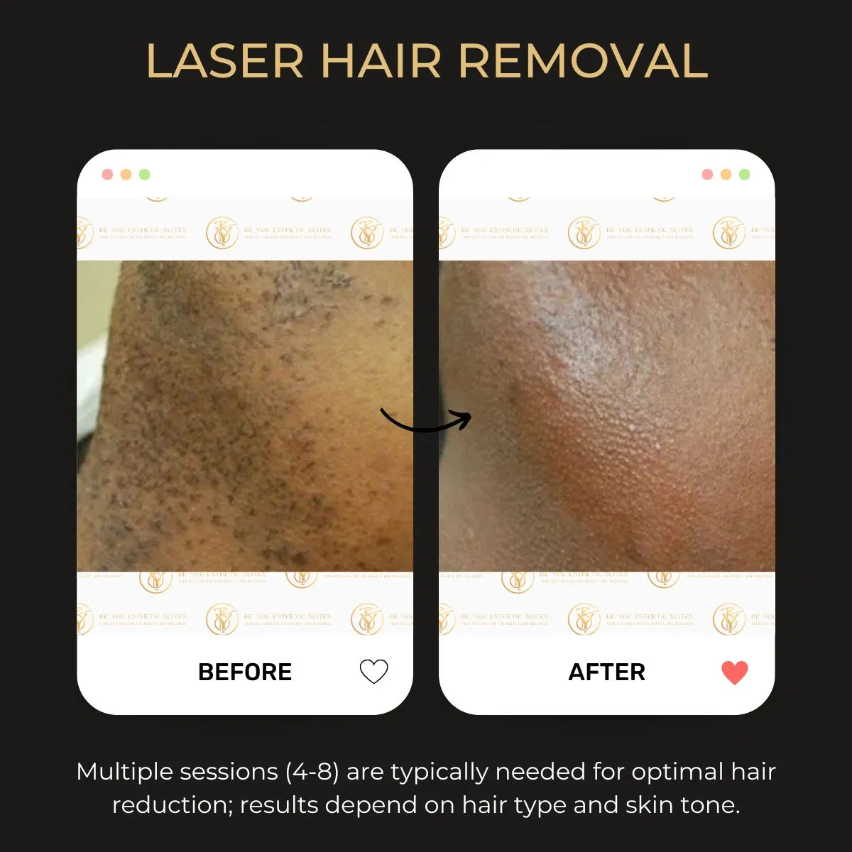 Laser hair removal before and after — Be You Esthetic Suites.