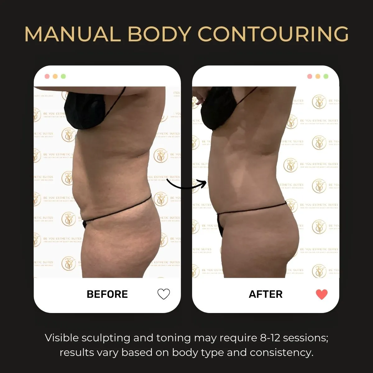 Manual body contouring before and after — Be You Esthetic Suites.