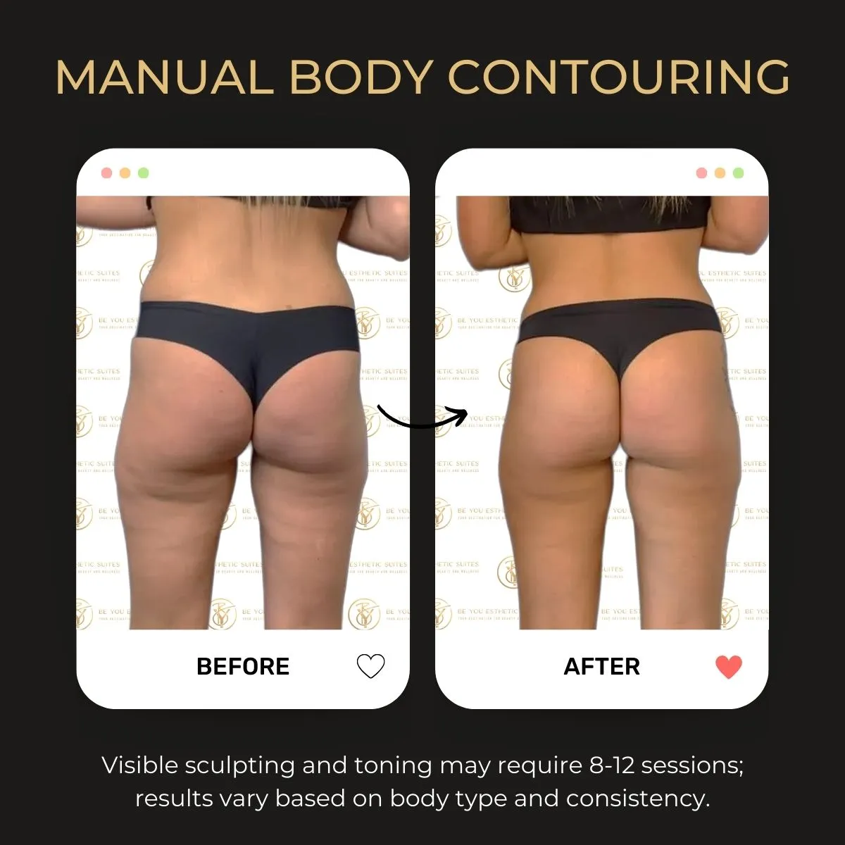 Manual body contouring before and after — Be You Esthetic Suites.