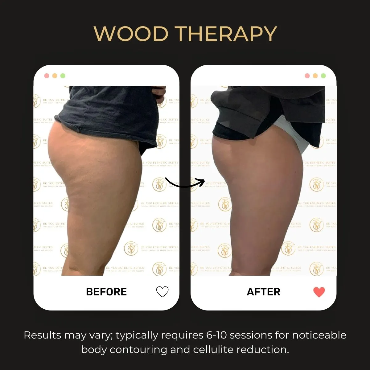 Wood therapy massage before and after — Be You Esthetic Suites.