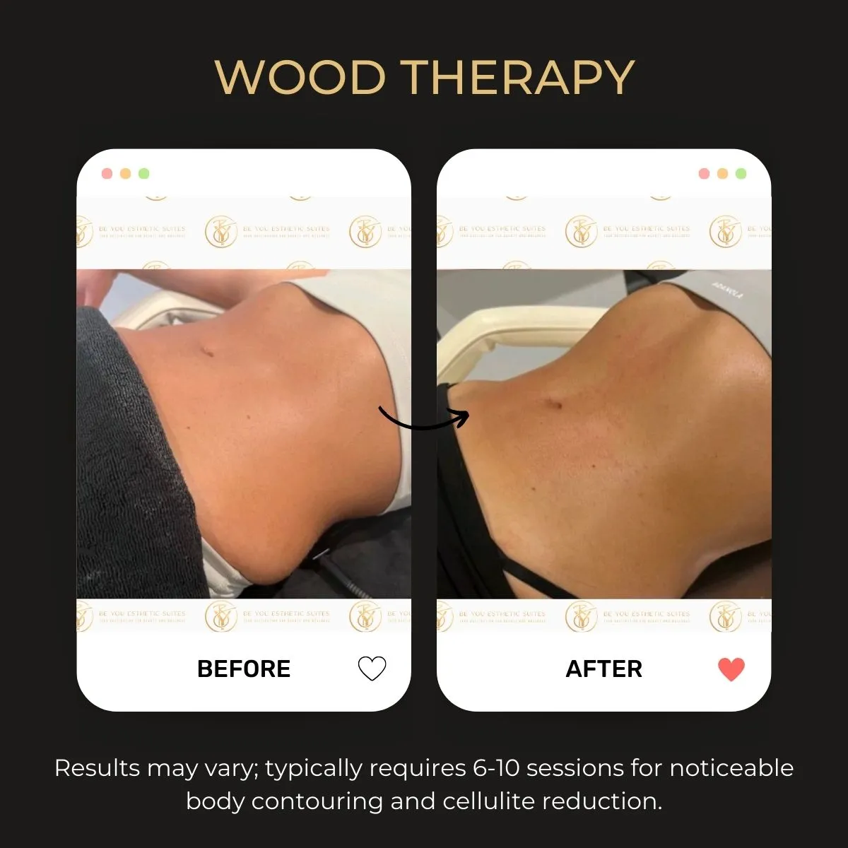 Wood therapy massage before and after — Be You Esthetic Suites.
