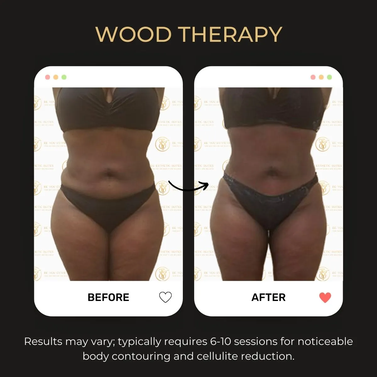 Wood therapy massage before and after — Be You Esthetic Suites.
