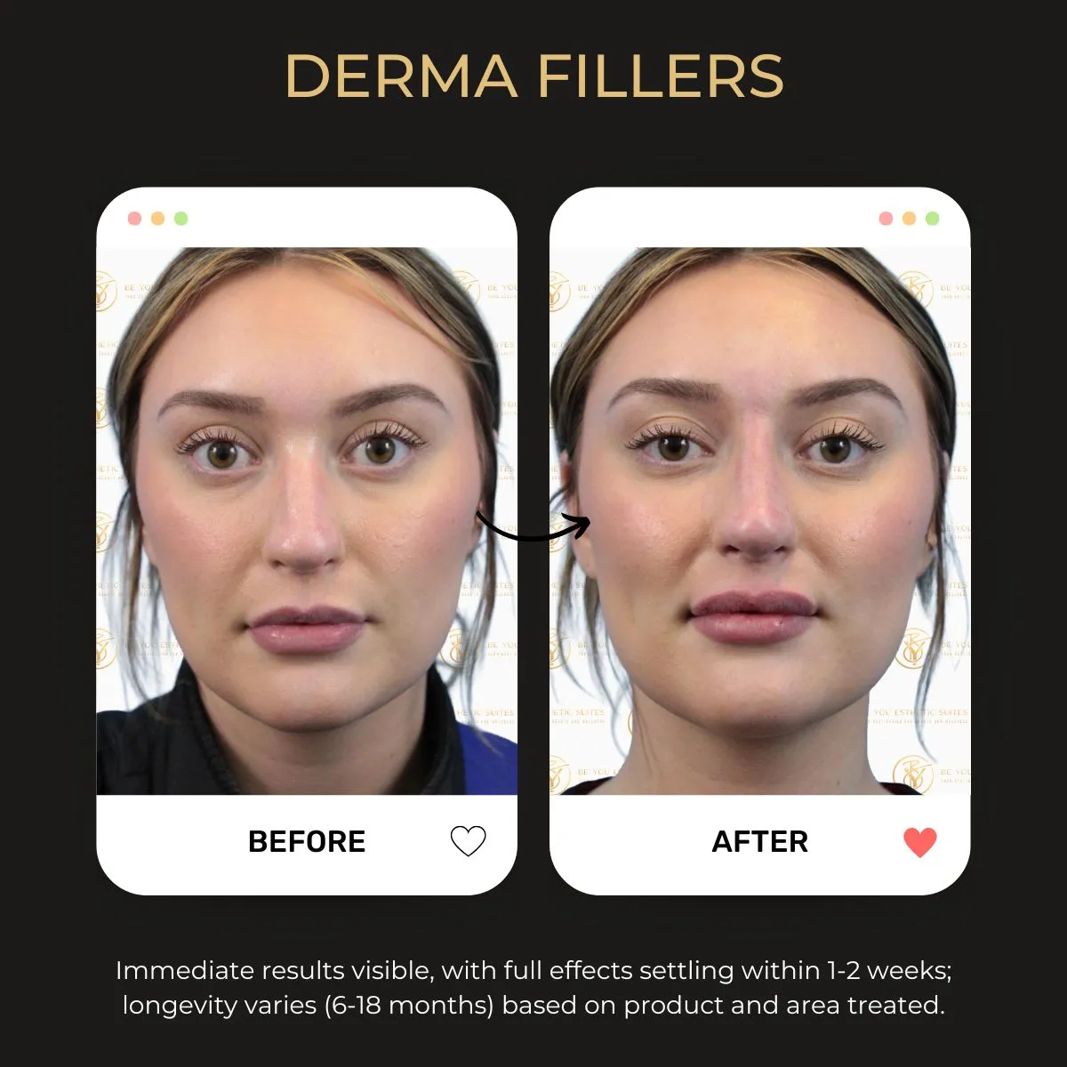Before and after body fillers results at Be You Esthetic Suites.