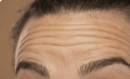 Time showing on your face — Botox.
