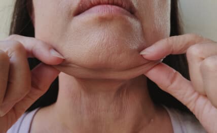 Self-conscious about double chin — Kybella.