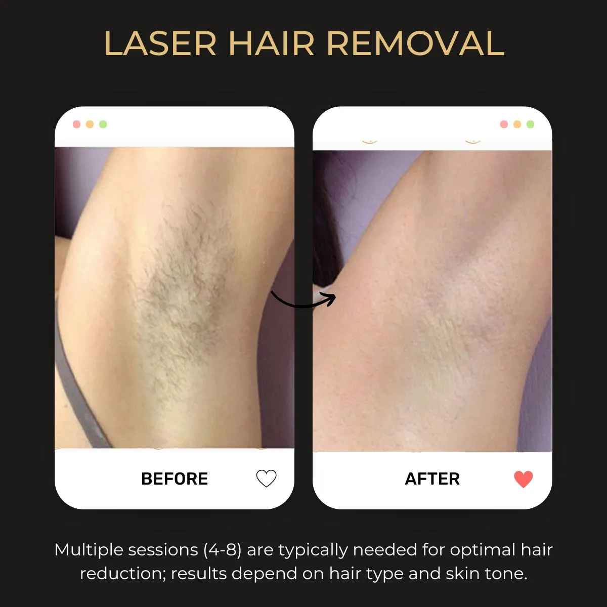 Before and after laser hair removal at Be You Esthetic Suites.
