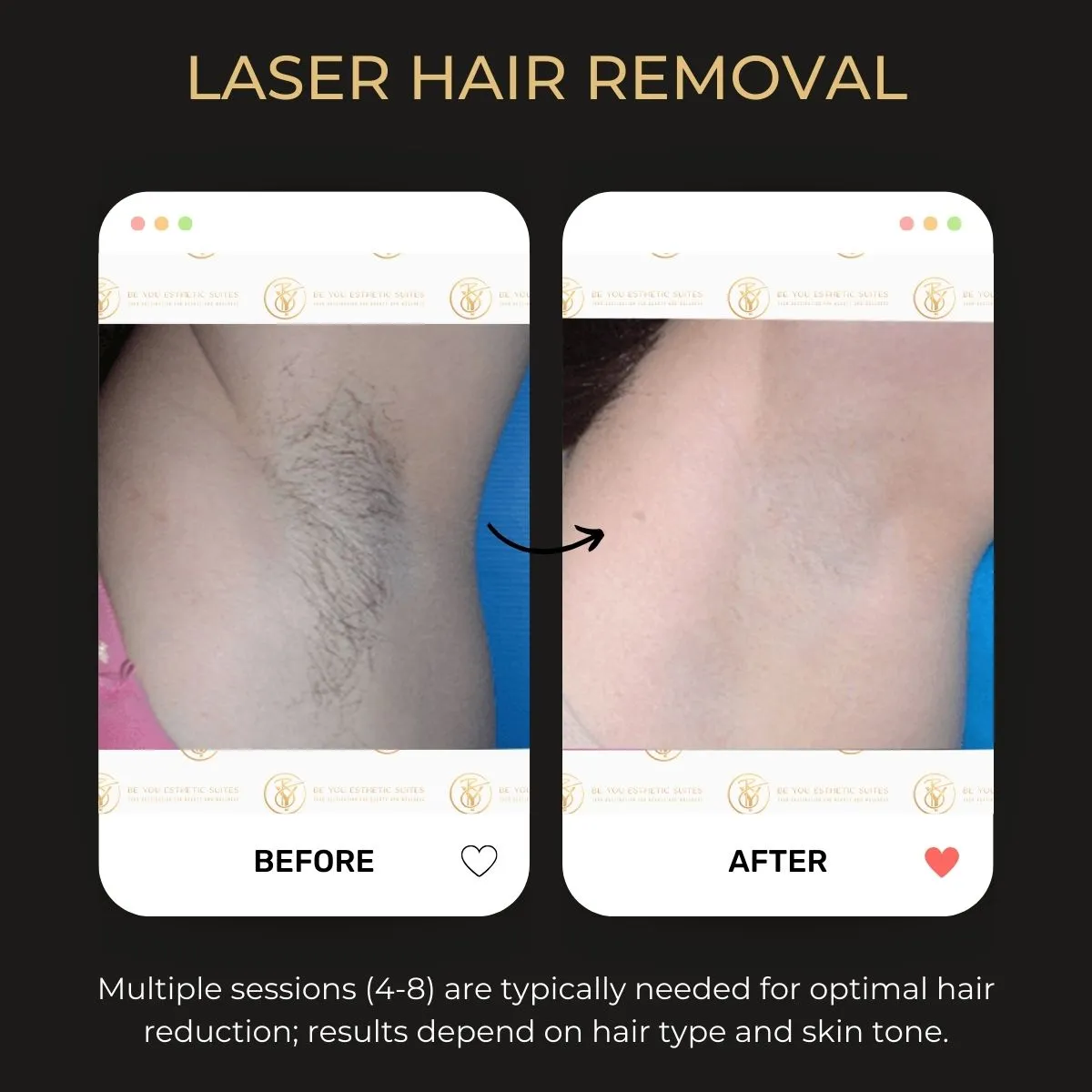 Before and after laser hair removal at Be You Esthetic Suites.