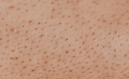 Close-up of skin with visible hair follicles, illustrating the challenges of traditional hair removal methods.