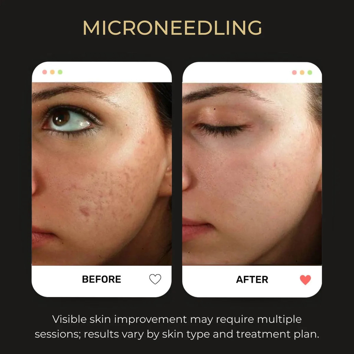 Before and after microneedling at Be You Esthetic Suites.