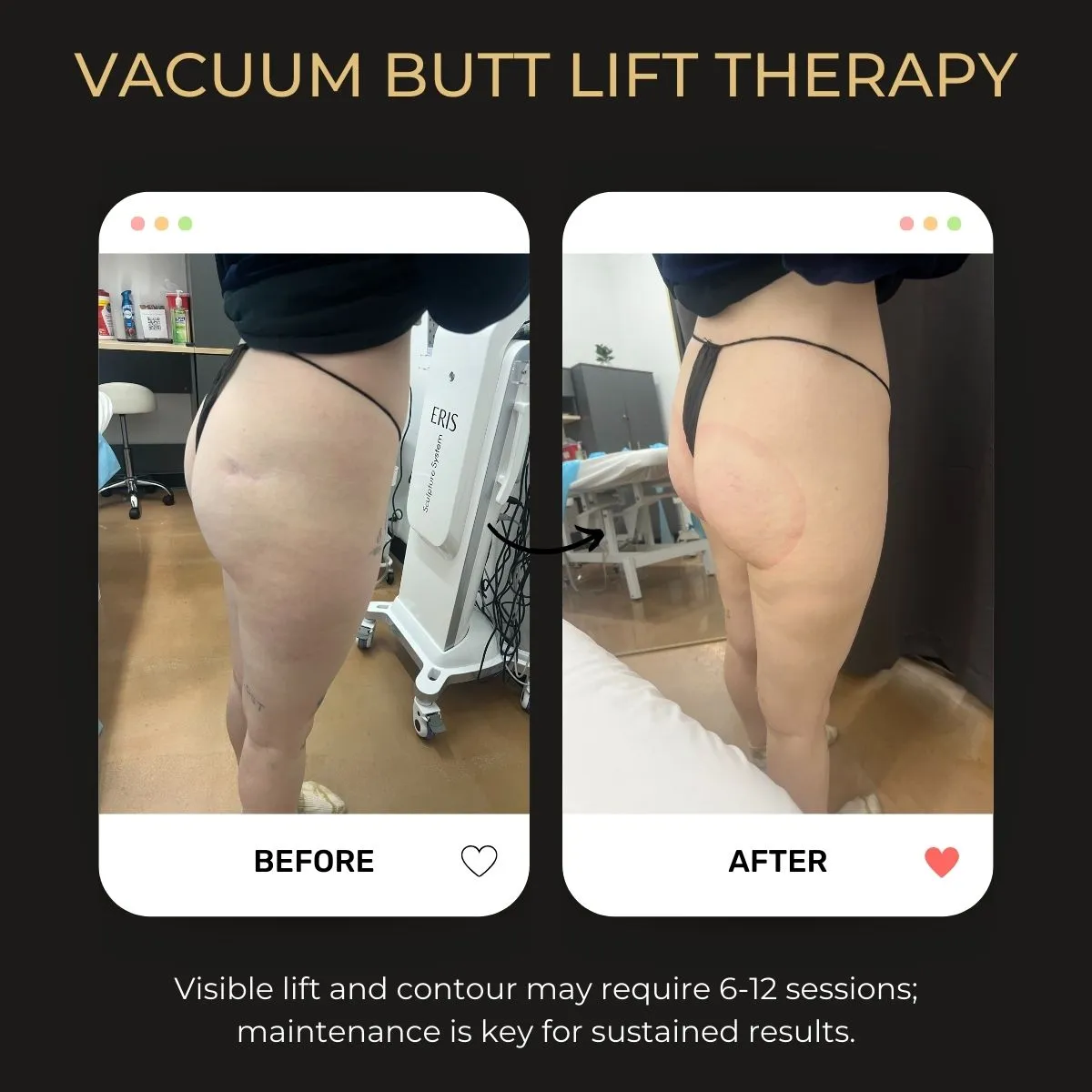 Before-and-after comparison of Vacuum Butt Lift Therapy results at Be You Esthetic Suites in Brooklyn, NY.