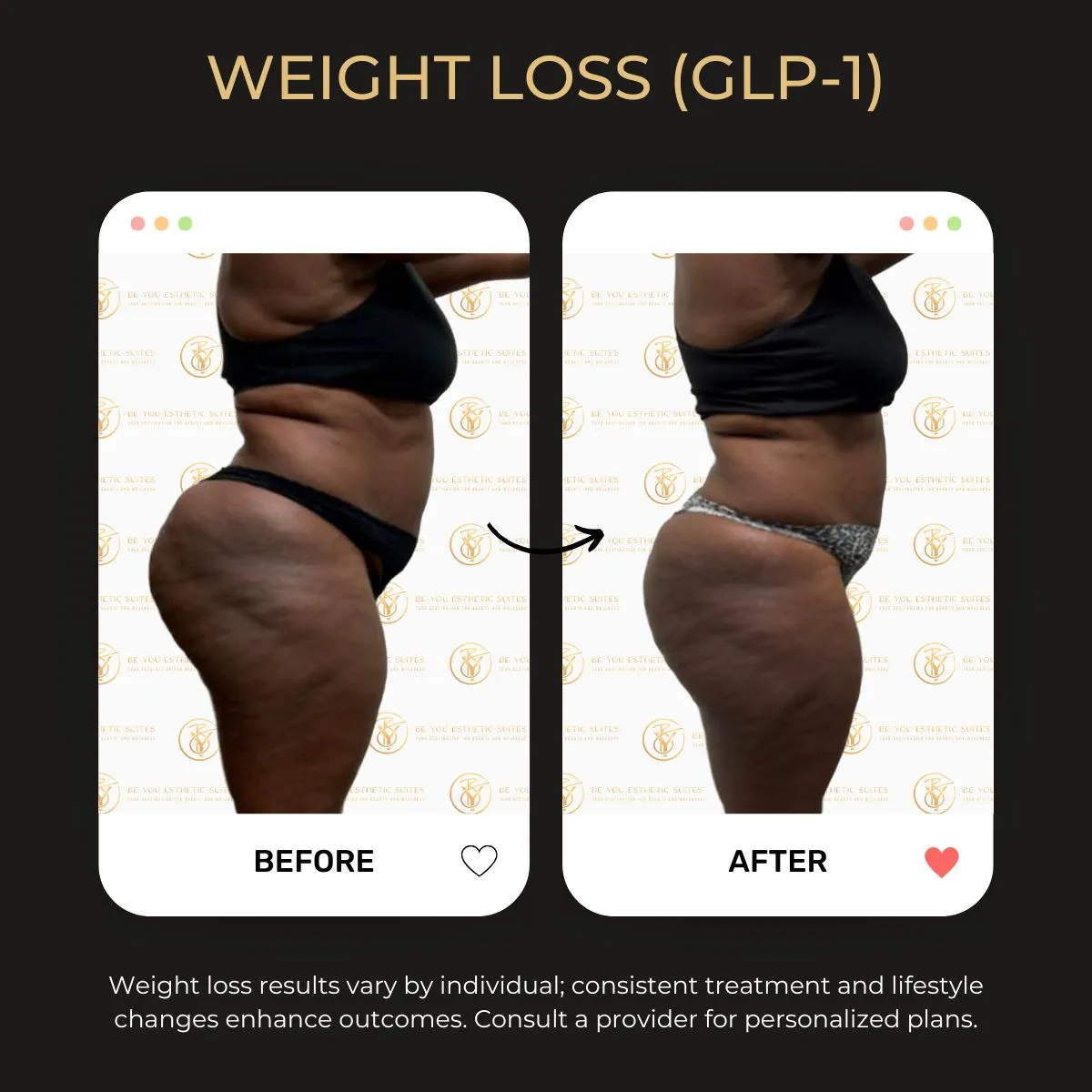 Before and after weight loss transformation showcasing body shape for Be You Esthetic Suites services.