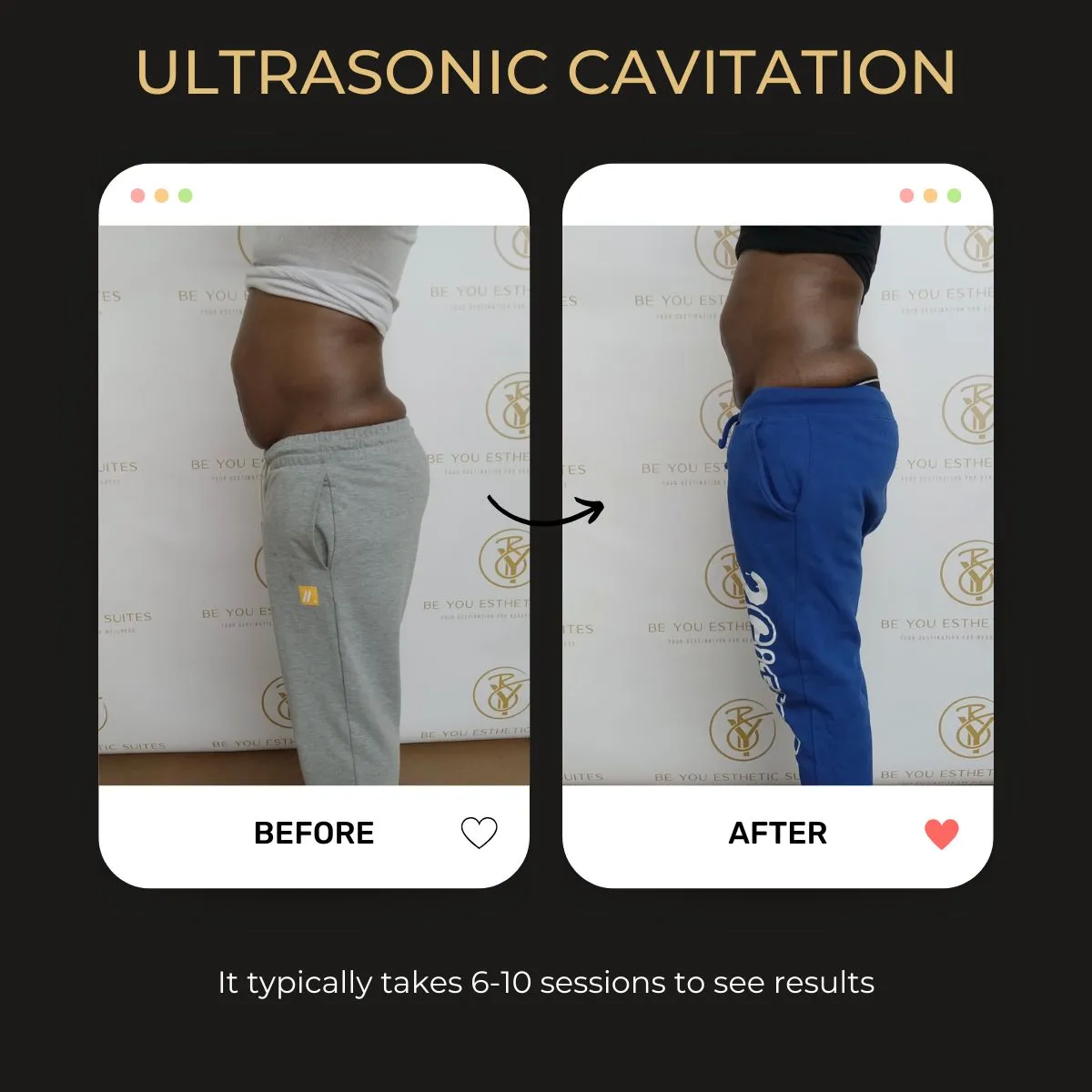 Ultrasonic Cavitation treatment at Be You Esthetic Suites in Brooklyn.